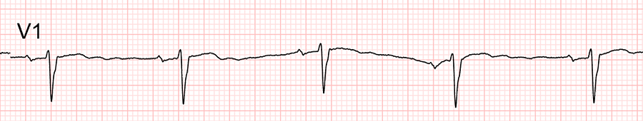 ECG standard : dérivation V1