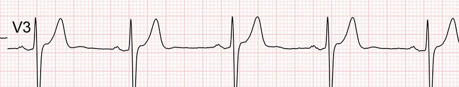 ECG standard : dérivation V3