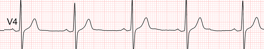 ECG standard : dérivation V4