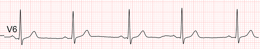 ECG standard : dérivation V6