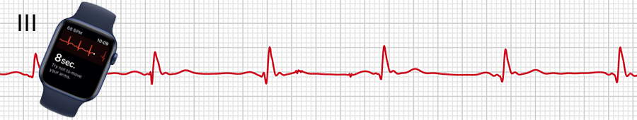ECG Apple Watch : dérivation III