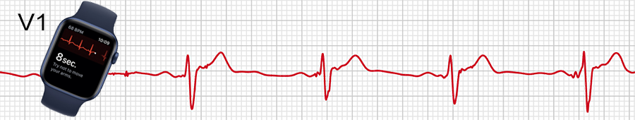 ECG apple watch : dérivation V1