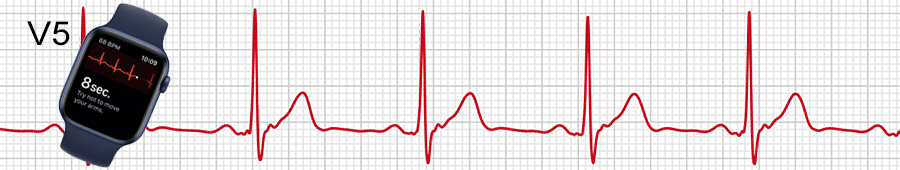 ECG apple watch : dérivation V5