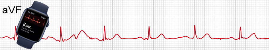 ECG apple watch : dérivation aVF