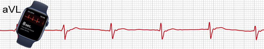 ECG Apple Watch : dérivation aVL