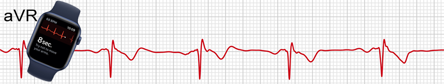 ECG Apple Watch : dérivation aVR